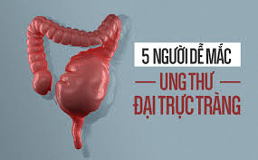 Colorectal cancers - Hình ảnh minh họa